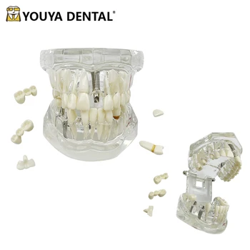 Nuimamas dantų modelis Dantų implantų restauravimo tiltas Dėstymas Studijos Medicinos mokslas Liga Odontologija Odontologija Burnos sveikata